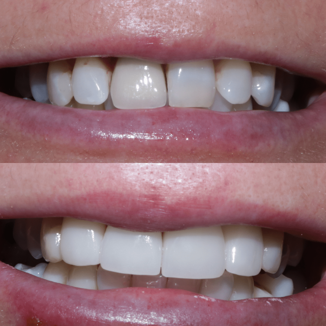 Crowns & Veneers Dr Caitlin Watson Glasgow Cosmetic Dentist