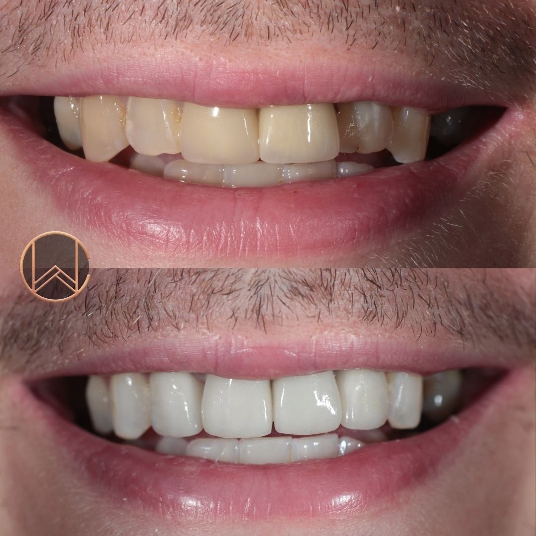 Crowns & Veneers Dr Caitlin Watson Glasgow Cosmetic Dentist